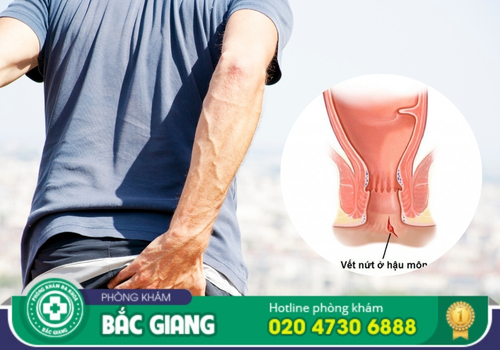 địa chỉ chữa bệnh nứt kẽ hậu môn tại bắc giang