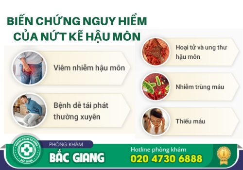 chi phí điều trị nứt kẽ hậu môn tại bắc giang