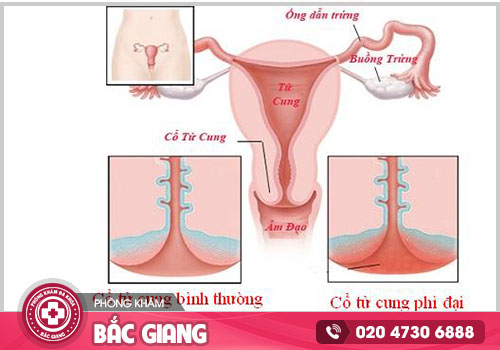 Phì đại cổ tử cung và những thông tin cần biết