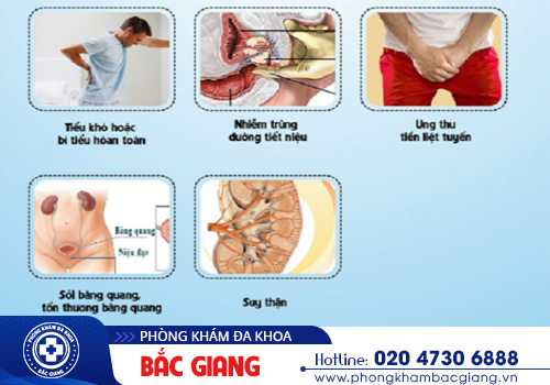 Bạn có thể vượt qua căn bệnh phì đại tuyến tiền liệt?