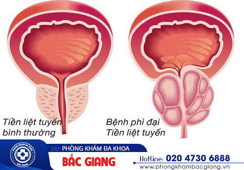 Bạn có thể vượt qua căn bệnh phì đại tuyến tiền liệt?