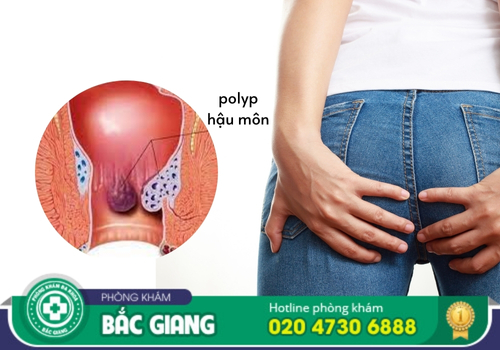 điều trị bệnh polyp hậu môn ở bắc giang