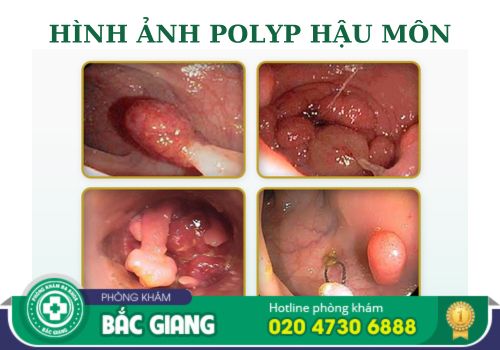 điều trị bệnh polyp hậu môn ở bắc giang