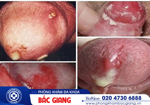 Quy đầu chảy mủ - Cảnh giác với triệu chứng nam khoa bất thường