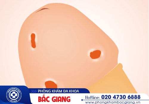 Quy đầu nổi đỏ: Nguyên nhân và Cách điều trị