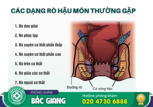 địa chỉ khám chữa rò rỉ hậu môn tại bắc giang