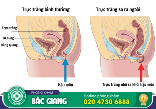 điều trị sa trực tràng tại bắc giang