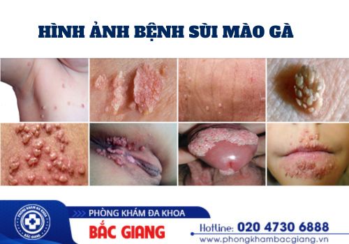 biểu hiện sùi mào gà