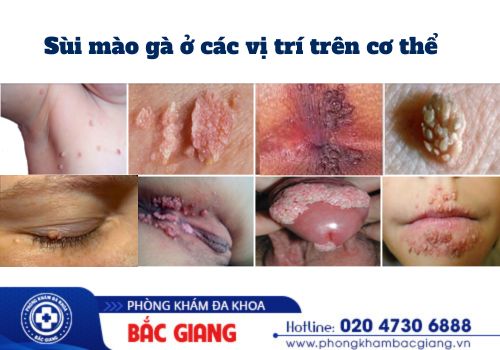 hình ảnh sùi mào gà