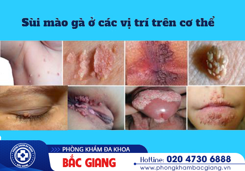 Sùi mào gà - Căn bệnh xã hội nguy hiểm với biến chứng không thể xem nhẹ