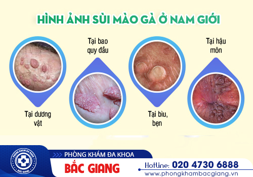 Sùi mào gà dương vật và những điều nam giới cần biết