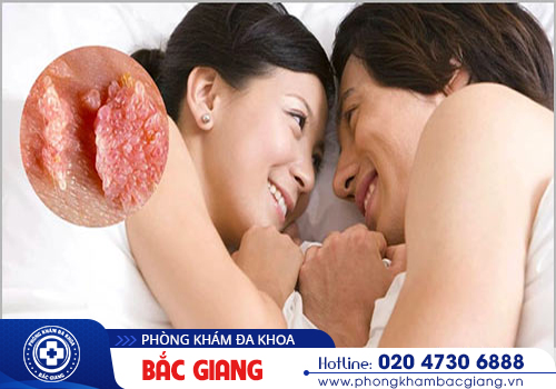 Sùi mào gà hậu môn - Nhận biết sớm, điều trị ngay, hạn chế nguy cơ biến chứng