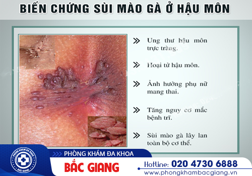 Sùi mào gà hậu môn - Nhận biết sớm, điều trị ngay, hạn chế nguy cơ biến chứng