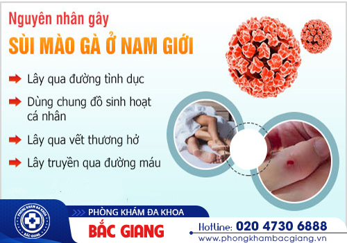 Sùi mào gà nam - Dấu hiệu nhận biết sớm và biện pháp điều trị