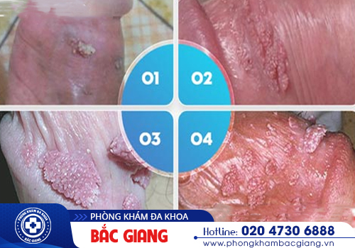 Sùi mào gà nam - Dấu hiệu nhận biết sớm và biện pháp điều trị