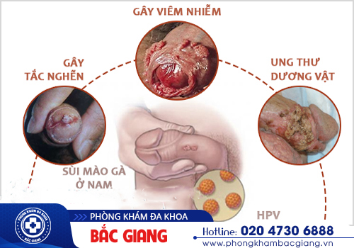Sùi mào gà dương vật và những điều nam giới cần biết