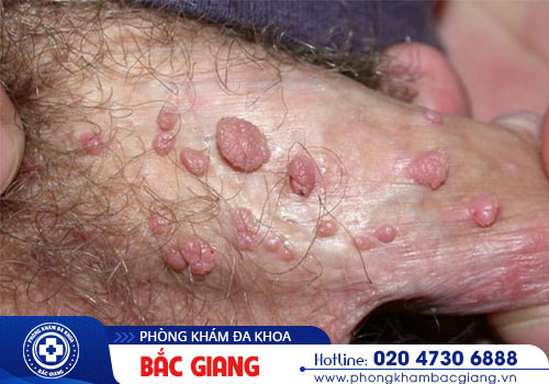 Sùi mào gà ở dương vật nguyên nhân do đâu? Có nguy hiểm không?