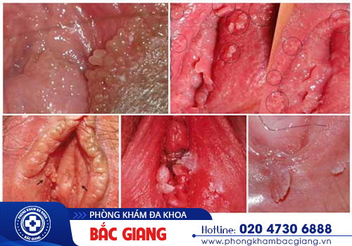 Nhận biết sùi mào gà âm đạo và hướng điều trị kịp thời nếu không may nhiễm bệnh