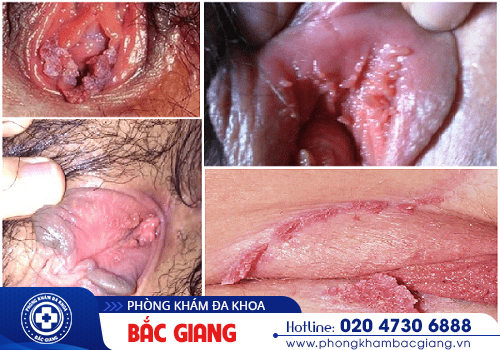 Phát hiện sớm sùi mào gà vùng kín, chủ động khám chữa kịp thời