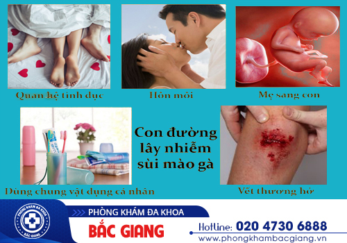 Sùi mào gà ở nữ giới và những thông tin cần thiết