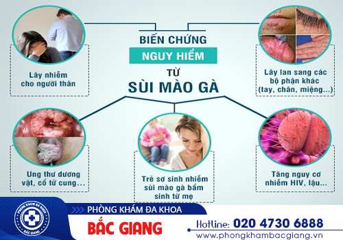 Đốt sùi mào gà và những điều cần biết khi điều trị