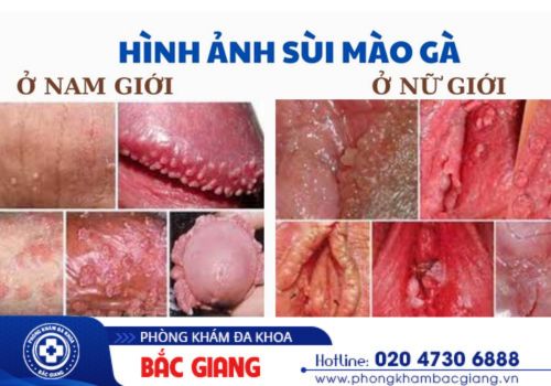 thuốc trị sùi mào gà