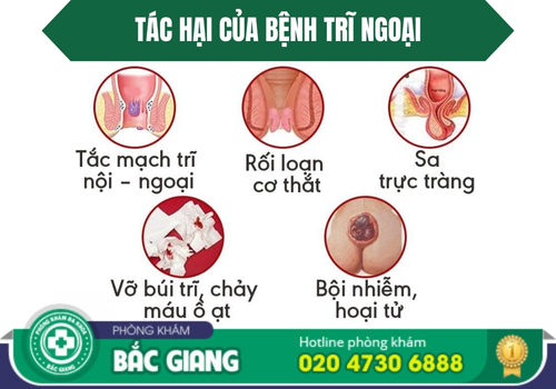 địa chỉ chữa bệnh trĩ ngoại ở bắc giang