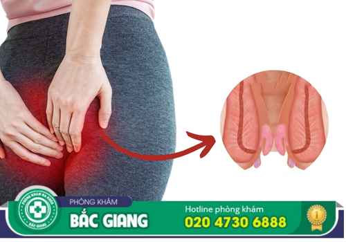 thịt dư hậu môn