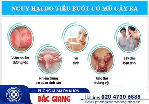 Tiểu buốt có mủ trắng đục là bị gì? - Cẩn thận với căn bệnh xã hội lậu