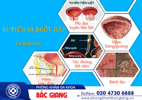 Tiểu buốt có sao không? Dấu hiệu lâm sàng của nhiều bệnh lý khác nhau