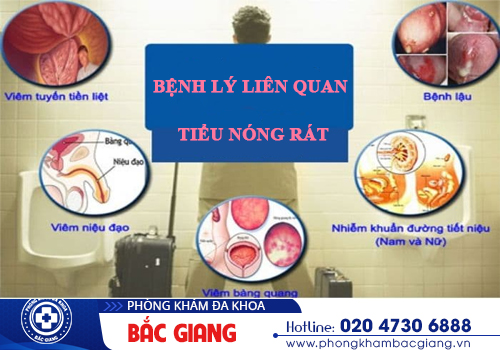 Tiểu nóng rát là bị gì? Điều trị như thế nào?