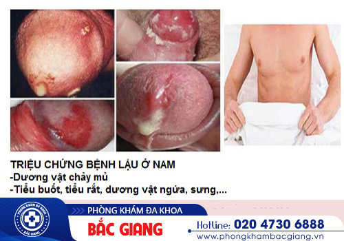Tiểu ra mủ ở nam giới là bệnh gì? Có phải dấu hiệu của bệnh lậu?