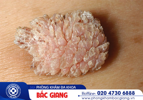 Tìm hiểu phương pháp hỗ trợ điều trị sùi mào gà hiện nay