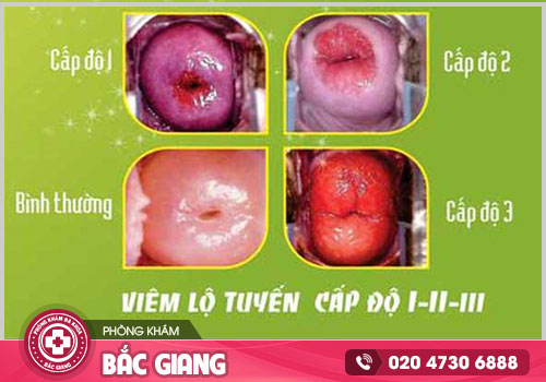 Tìm kiếm địa chỉ khám viêm lộ tuyến cổ tử cung tại Bắc Giang hiệu quả, an toàn