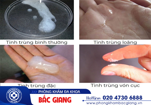 Nhận biết tinh trùng bất thường và nỗi lo vô sinh ở nam giới