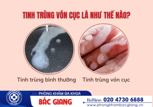 tinh trùng vón cục là bị làm sao