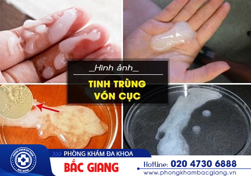 Tinh trùng vón cục như thạch nguy hiểm như thế nào? Cách khắc phục