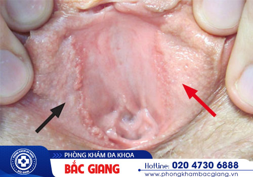 Tổng quan về bệnh sùi mào gà ở âm đạo