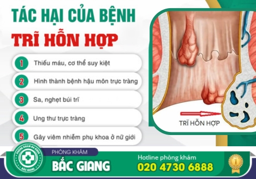 chữa bệnh trĩ hỗn hợp tại bắc giang