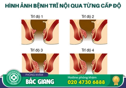 địa chỉ điều trị bệnh trĩ nội tại bắc giang