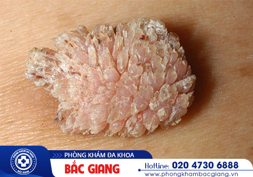 Trị sùi mào gà có đắt không?