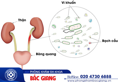 Trị viêm đường tiết niệu ở đâu hiệu quả, an toàn tại Bắc Giang?