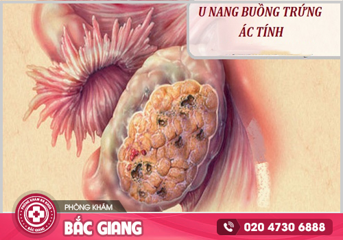 Bệnh phụ khoa cần kịp thời chữa trị