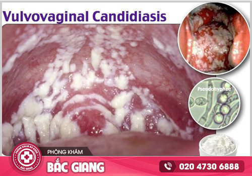 Bệnh phụ khoa cần kịp thời chữa trị