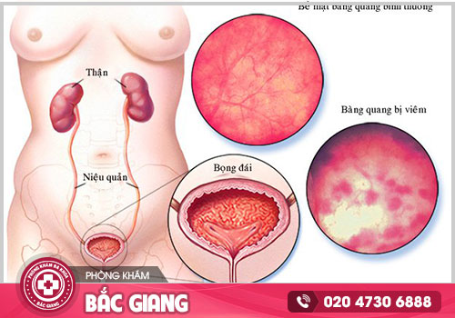Viêm Bàng Quang nữ - Chớ nên xem thường