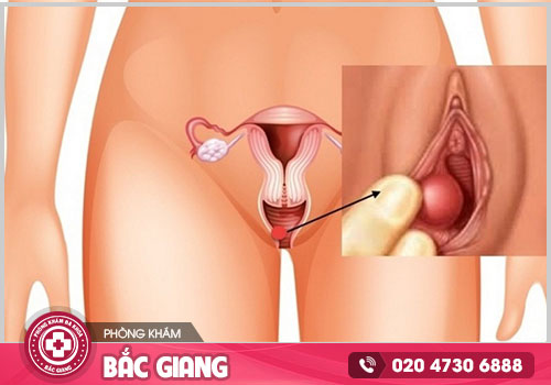 Viêm Bartholin là gì? Triệu chứng, Nguyên nhân và Cách điều trị