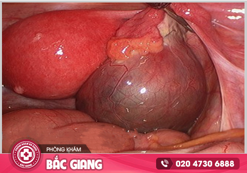 Chi phí điều trị viêm buồng trứng tại Bắc Giang hết bao nhiêu tiền?