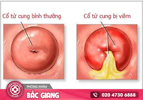 Viêm cổ tử cung ở nữ giới không thể chủ quan
