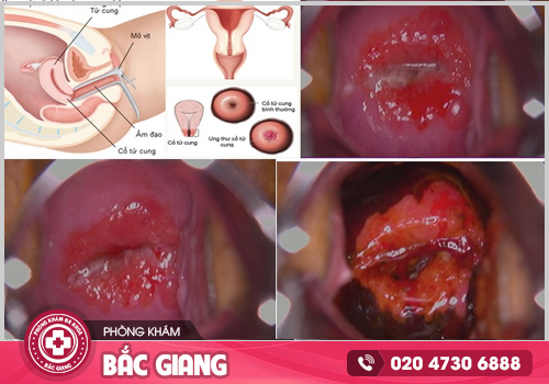 Bệnh phụ khoa cần kịp thời chữa trị
