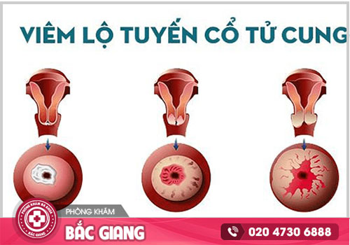 Viêm lộ tuyến CTC là gì? Nguyên nhân và Biểu hiện của bệnh qua từng cấp độ